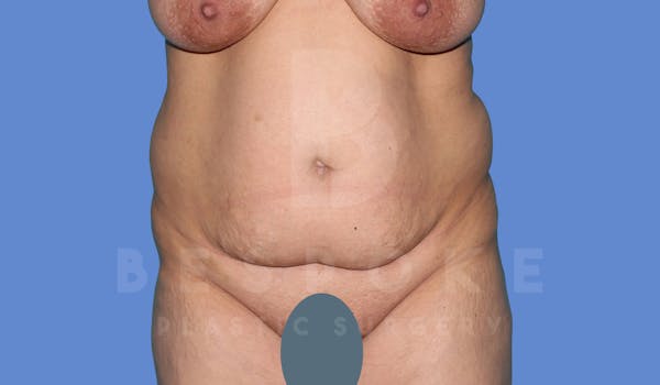Tummy Tuck Before & After Gallery - Patient 143824401 - Image 1