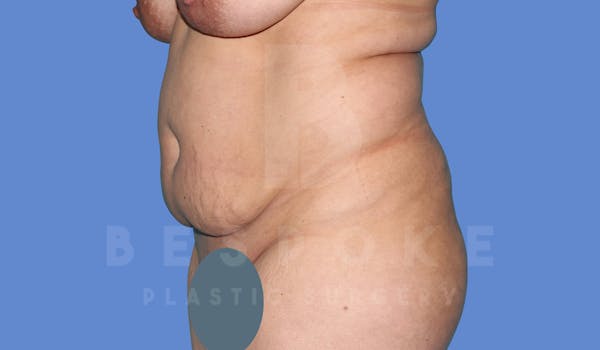 Tummy Tuck Before & After Gallery - Patient 143824401 - Image 3