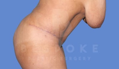 Tummy Tuck Before & After Gallery - Patient 143824401 - Image 6