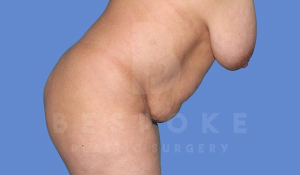 Tummy Tuck Before & After Gallery - Patient 143824401 - Image 5