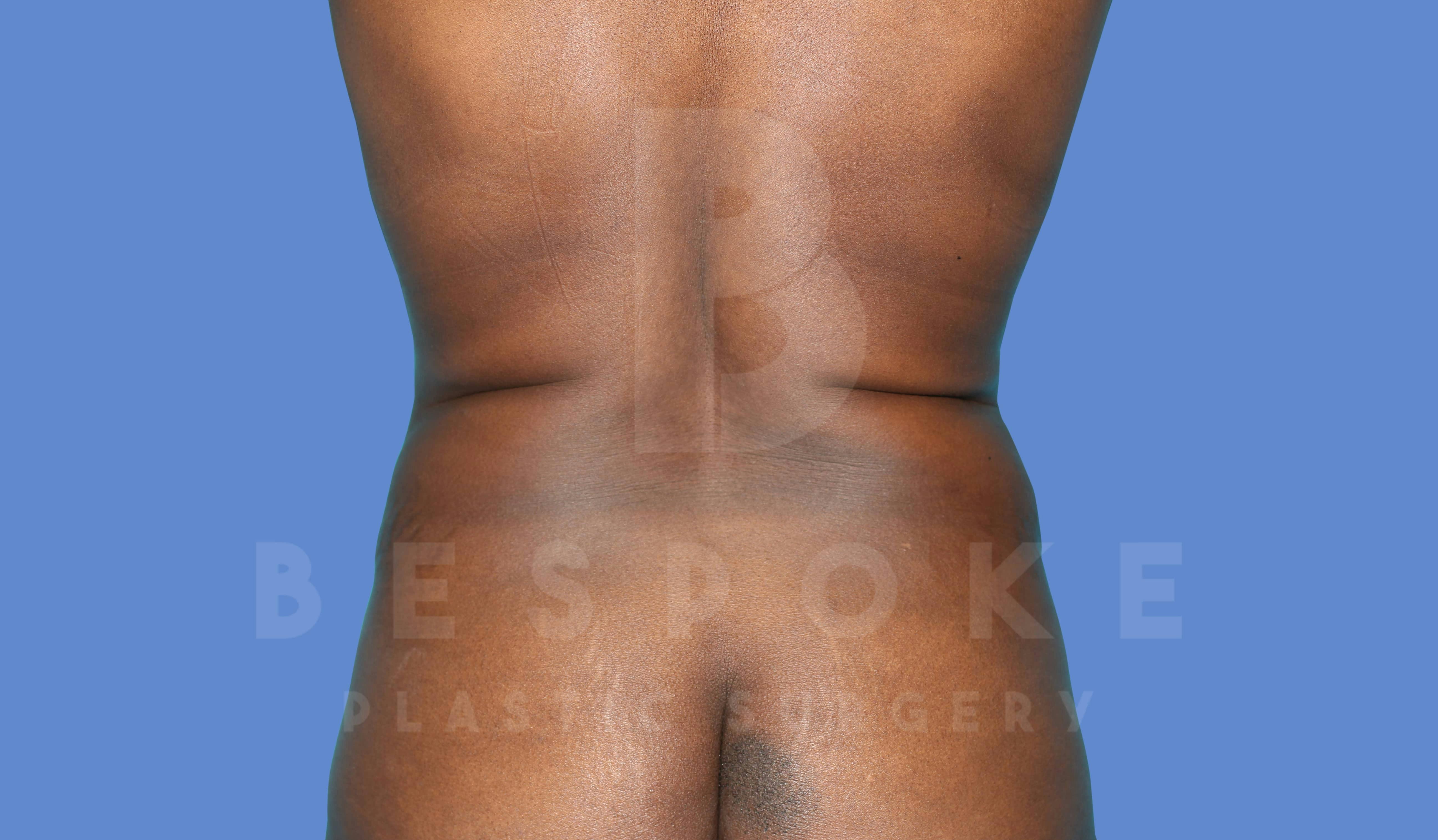 Liposuction Before & After Gallery - Patient 143824467 - Image 1