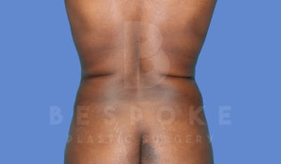 Liposuction Before & After Gallery - Patient 143824467 - Image 1