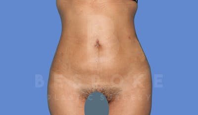 Liposuction Before & After Gallery - Patient 143824466 - Image 2