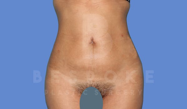 Liposuction Before & After Gallery - Patient 143824466 - Image 2