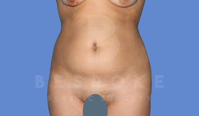 Liposuction Before & After Gallery - Patient 143824466 - Image 1