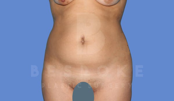Liposuction Before & After Gallery - Patient 143824466 - Image 1