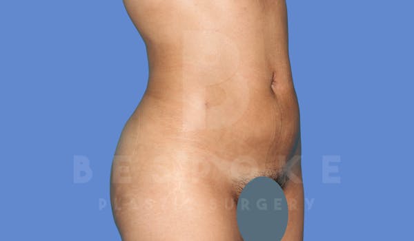 Liposuction Before & After Gallery - Patient 143824466 - Image 4