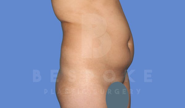 Liposuction Before & After Gallery - Patient 143824466 - Image 3
