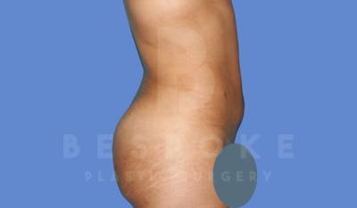 Liposuction Before & After Gallery - Patient 143824466 - Image 6