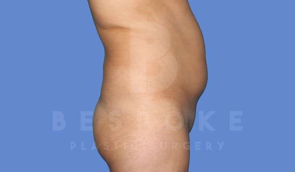 Liposuction Before & After Gallery - Patient 143824466 - Image 5