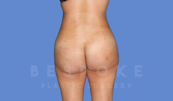 Liposuction Before & After Gallery - Patient 143824468 - Image 2