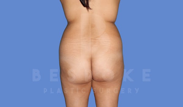 Liposuction Before & After Gallery - Patient 143824468 - Image 1