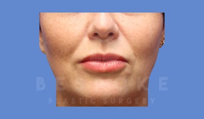 Facial Fat Grafting Before & After Gallery - Patient 143824480 - Image 2