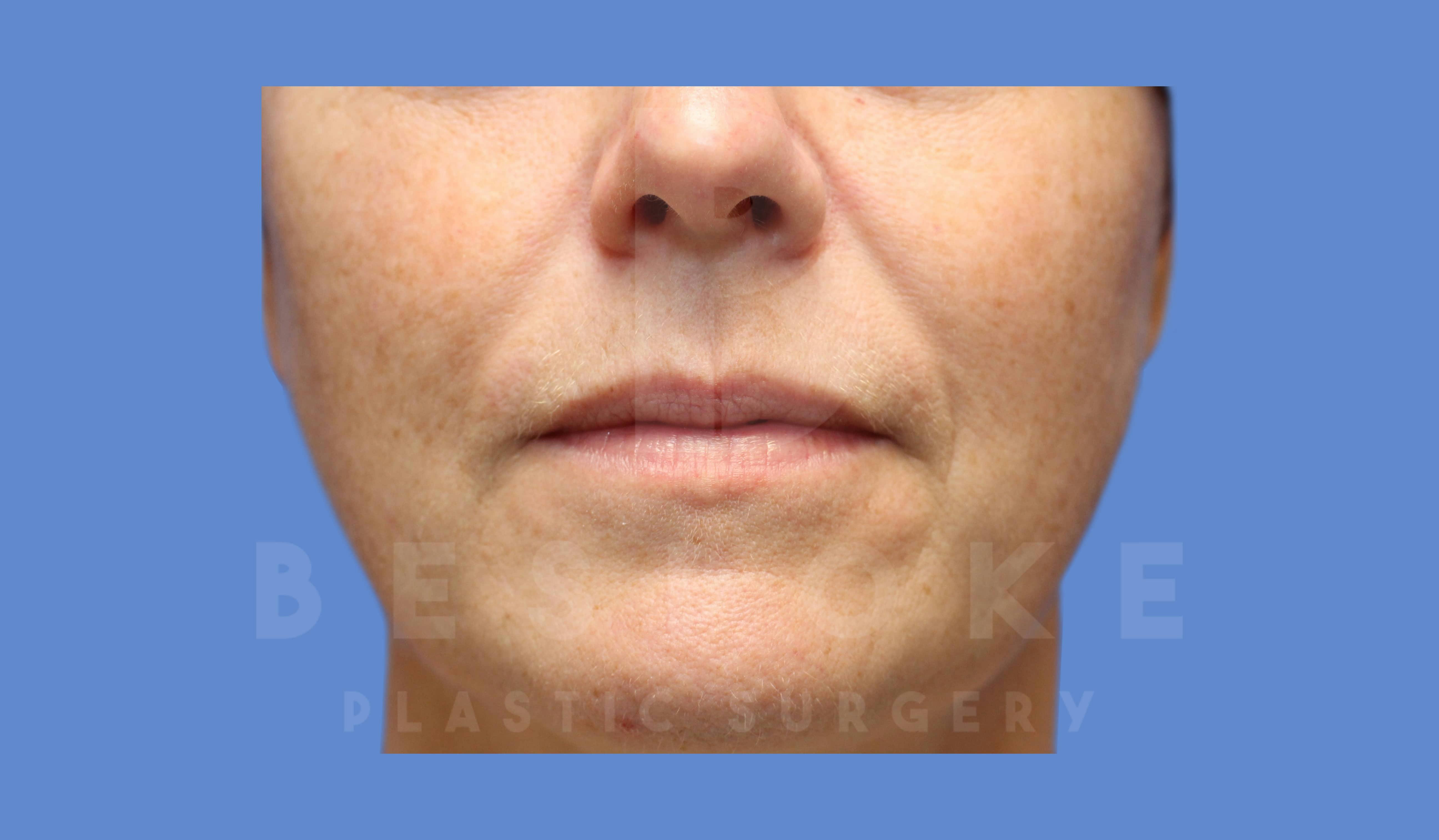 Facial Fat Grafting Before & After Gallery - Patient 143824480 - Image 1