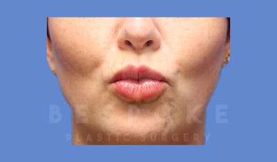 Facial Fat Grafting Before & After Gallery - Patient 143824480 - Image 4