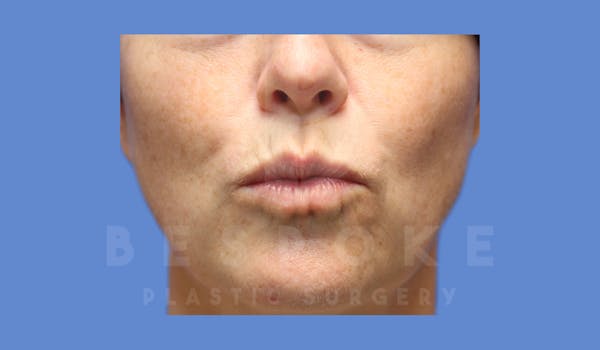 Facial Fat Grafting Before & After Gallery - Patient 143824480 - Image 3