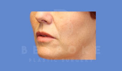 Facial Fat Grafting Before & After Gallery - Patient 143824480 - Image 6