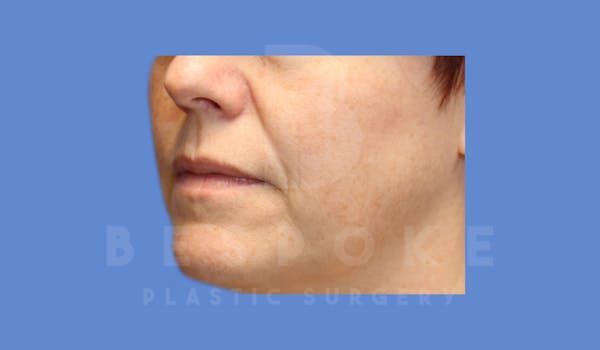 Facial Fat Grafting Before & After Gallery - Patient 143824480 - Image 5