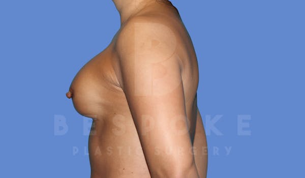 Breast Revision Surgery Before & After Gallery - Patient 143824494 - Image 3