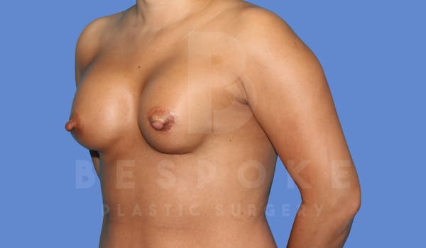 Breast Revision Surgery Before & After Gallery - Patient 143824494 - Image 5