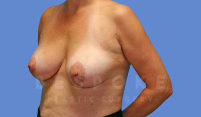 Breast Lift With Implants Before & After Gallery - Patient 143825131 - Image 4