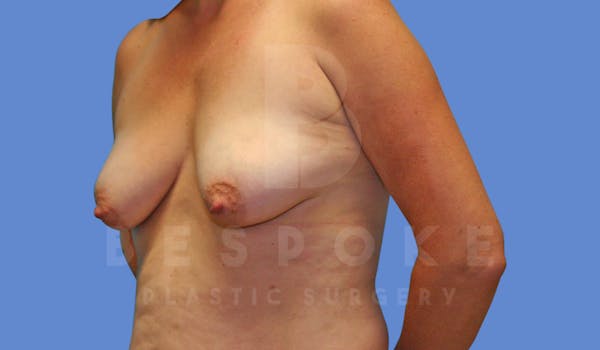 Breast Lift With Implants Before & After Gallery - Patient 143825131 - Image 3