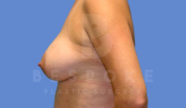 Breast Lift With Implants Before & After Gallery - Patient 143825131 - Image 6