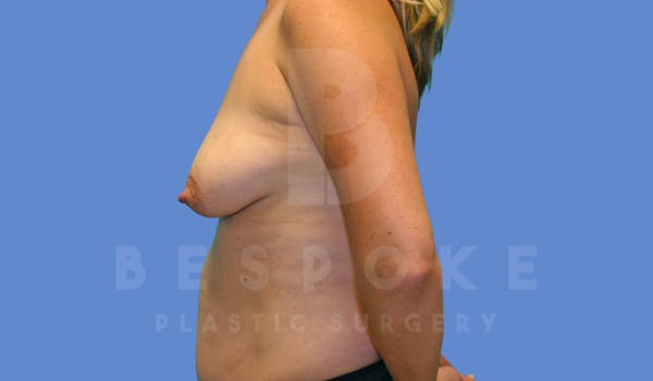 Breast Lift With Implants Before & After Gallery - Patient 143825131 - Image 5
