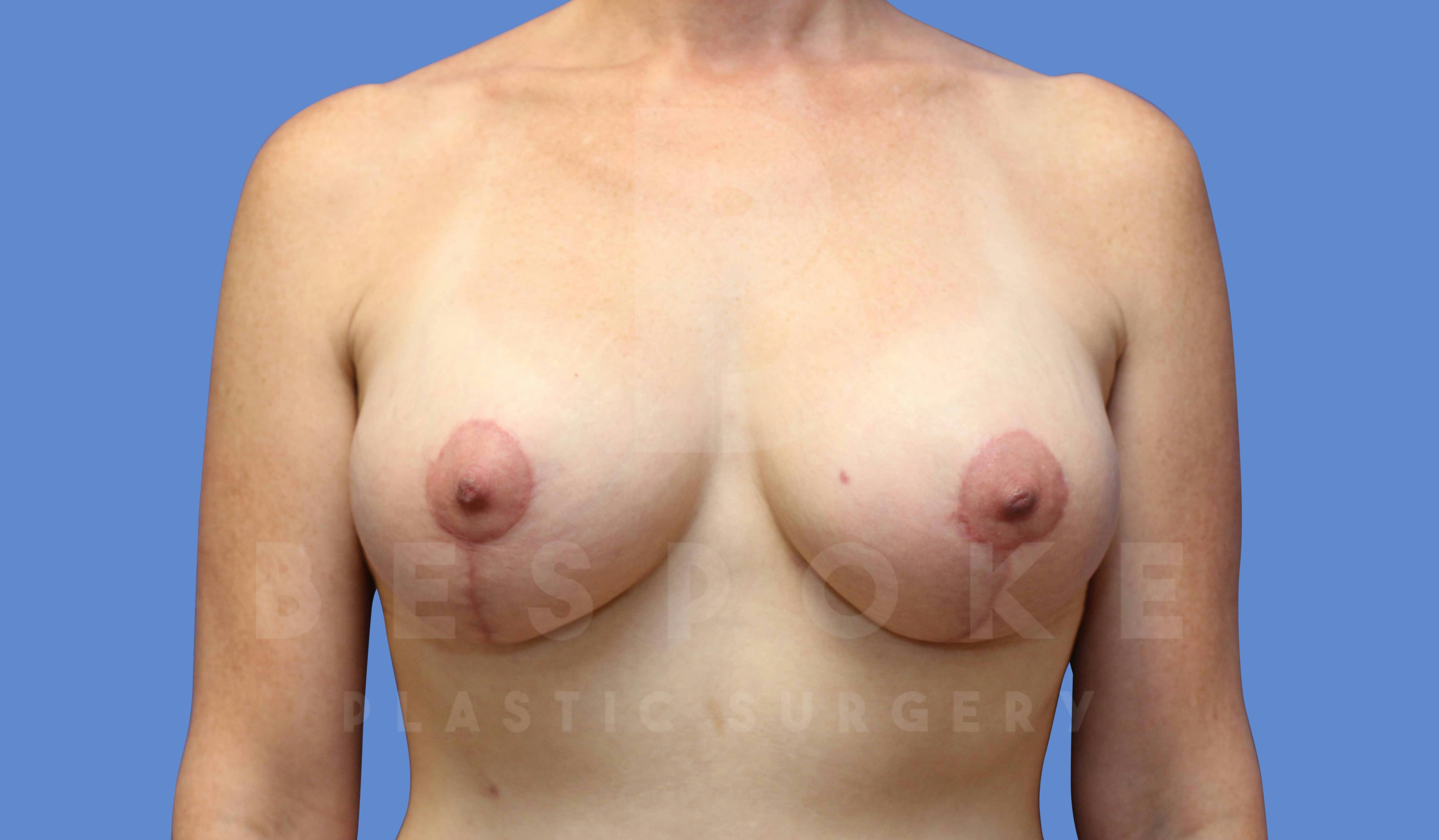 Breast Lift With Implants Before & After Gallery - Patient 143825132 - Image 2