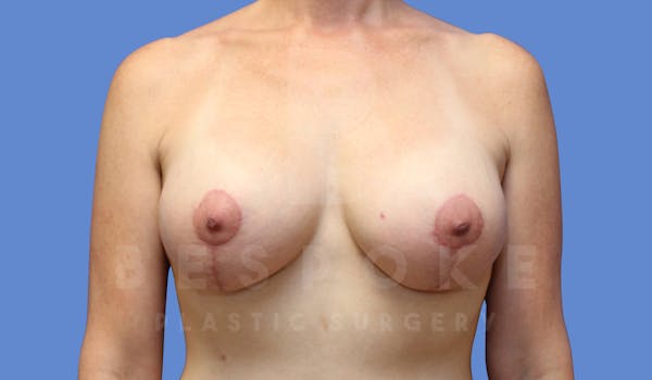 Breast Lift With Implants Before & After Gallery - Patient 143825132 - Image 2