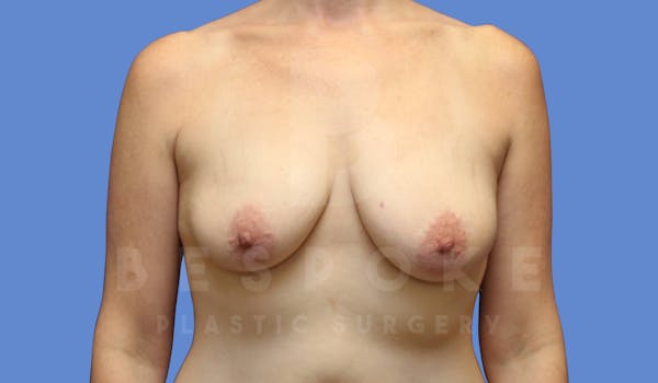 Breast Lift With Implants Before & After Gallery - Patient 143825132 - Image 1