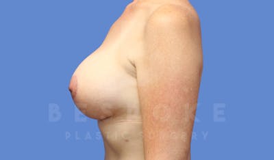 Breast Lift With Implants Before & After Gallery - Patient 143825132 - Image 6