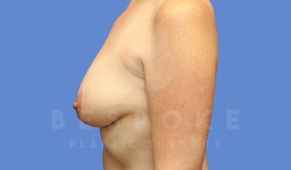 Breast Lift With Implants Before & After Gallery - Patient 143825132 - Image 5