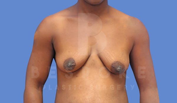 Breast Lift With Implants Before & After Gallery - Patient 143825133 - Image 1