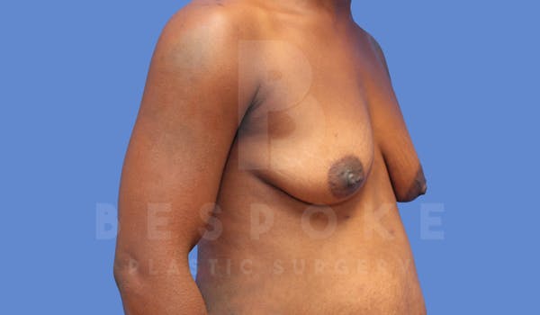 Breast Lift With Implants Before & After Gallery - Patient 143825133 - Image 3