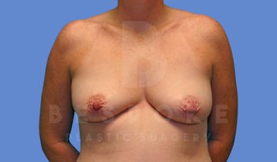 Breast Lift With Implants Before & After Gallery - Patient 143825134 - Image 1