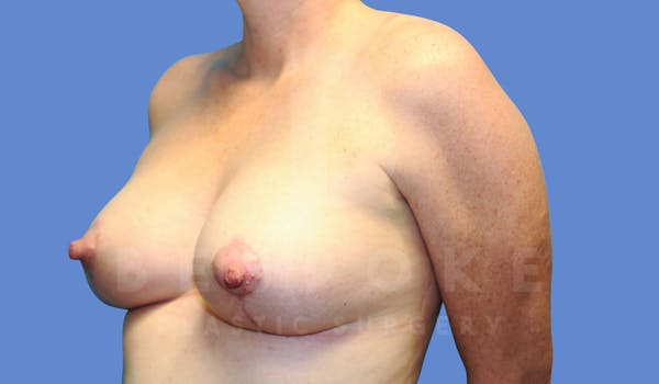 Breast Lift With Implants Before & After Gallery - Patient 143825134 - Image 4