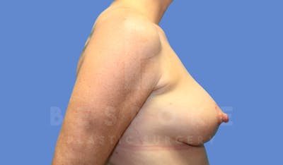 Breast Lift With Implants Before & After Gallery - Patient 143825134 - Image 6