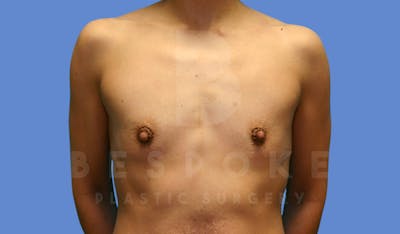 Breast Augmentation Before & After Gallery - Patient 143825167 - Image 1