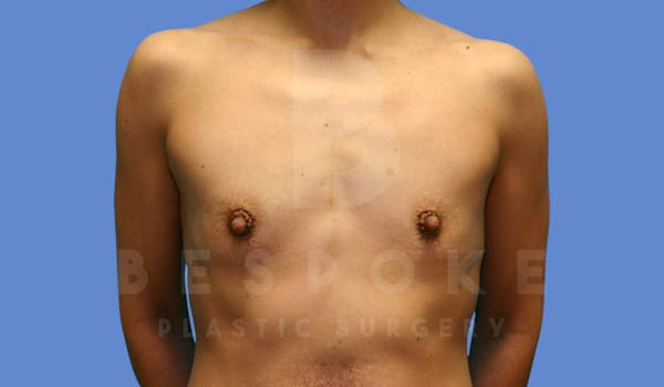 Breast Augmentation Before & After Gallery - Patient 143825167 - Image 1