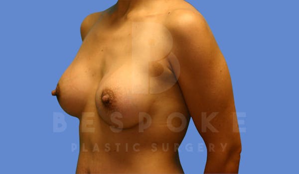 Breast Augmentation Before & After Gallery - Patient 143825167 - Image 4