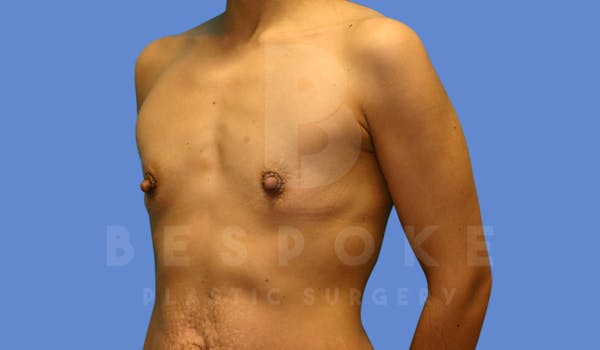 Breast Augmentation Before & After Gallery - Patient 143825167 - Image 3