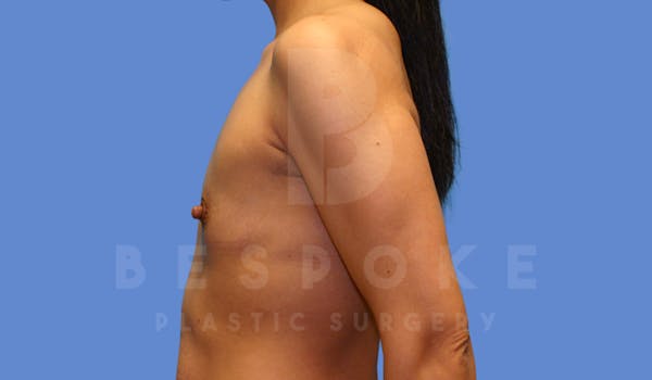 Breast Augmentation Before & After Gallery - Patient 143825167 - Image 5