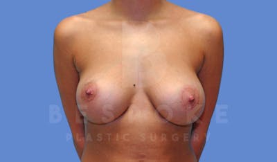 Breast Augmentation Before & After Gallery - Patient 143825168 - Image 2
