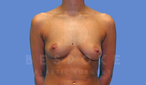 Breast Augmentation Before & After Gallery - Patient 143825168 - Image 1