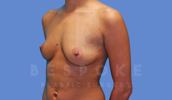 Breast Augmentation Before & After Gallery - Patient 143825168 - Image 3