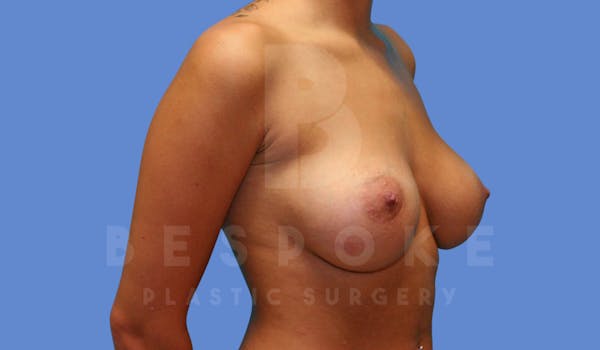 Breast Augmentation Before & After Gallery - Patient 143825168 - Image 6