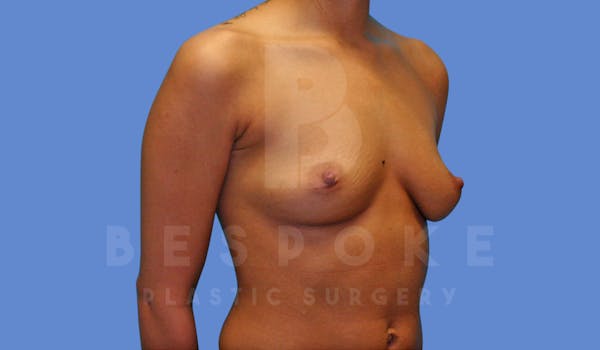 Breast Augmentation Before & After Gallery - Patient 143825168 - Image 5