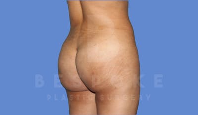 Brazilian Butt Lift Before & After Gallery - Patient 143825177 - Image 8
