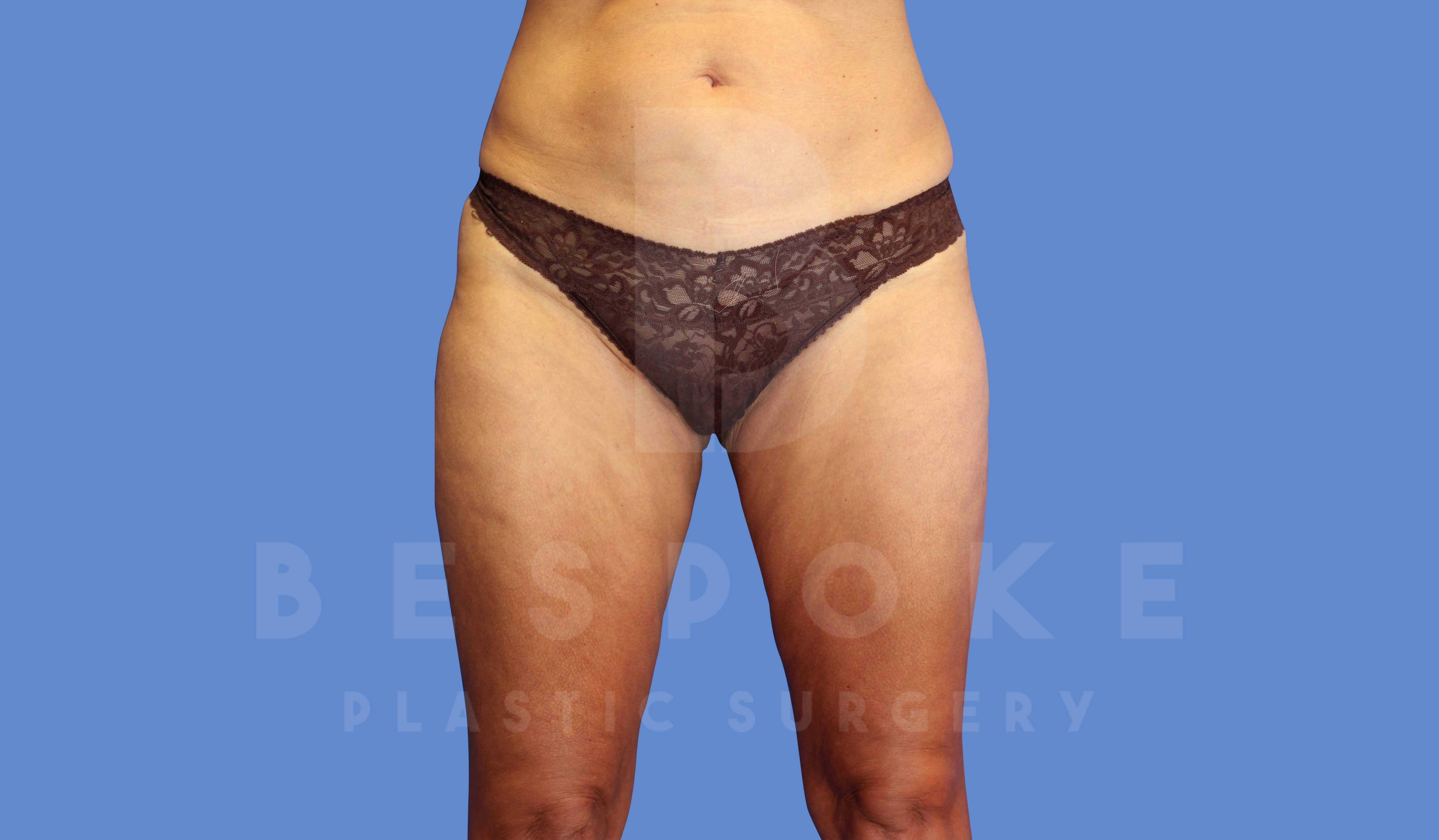 Liposuction Before & After Gallery - Patient 143826854 - Image 2